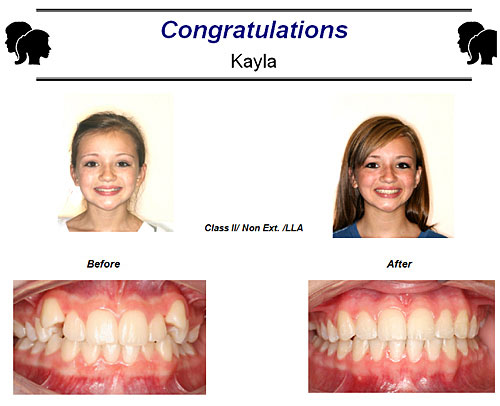 Before and After Case