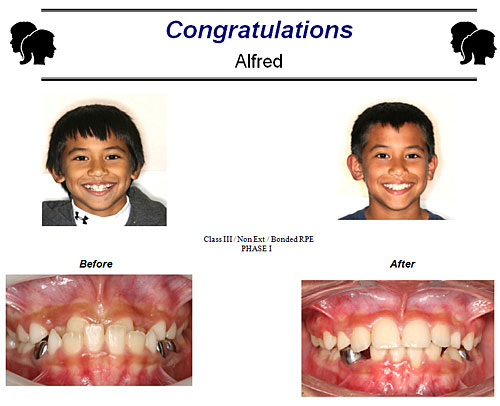 Before and After Case